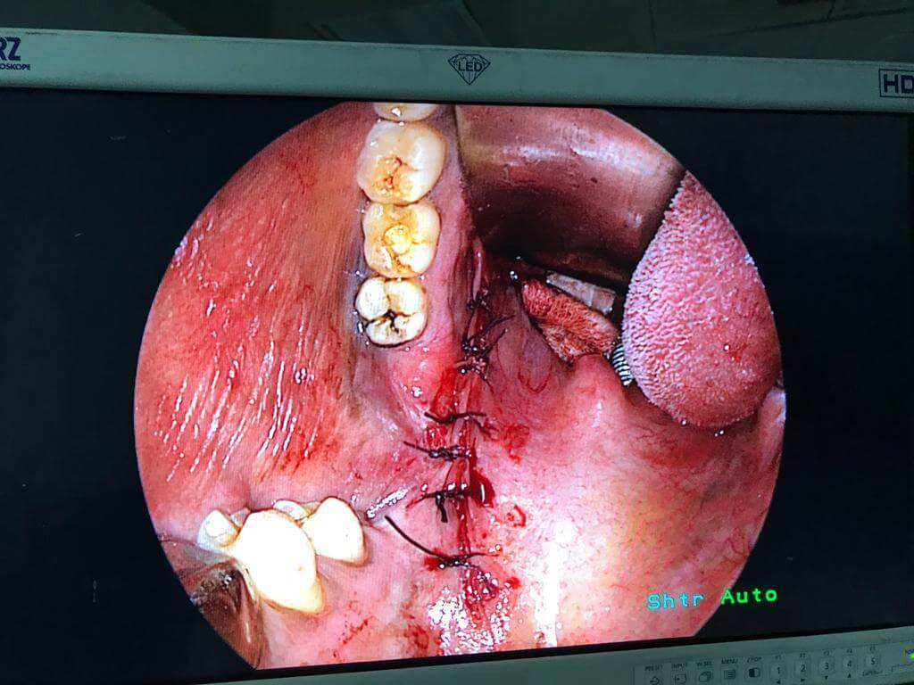 Minimal access ENT surgery