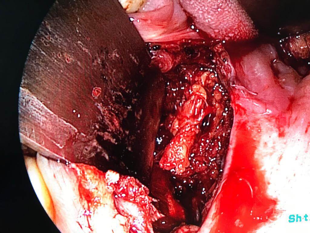 Minimal access ENT surgery