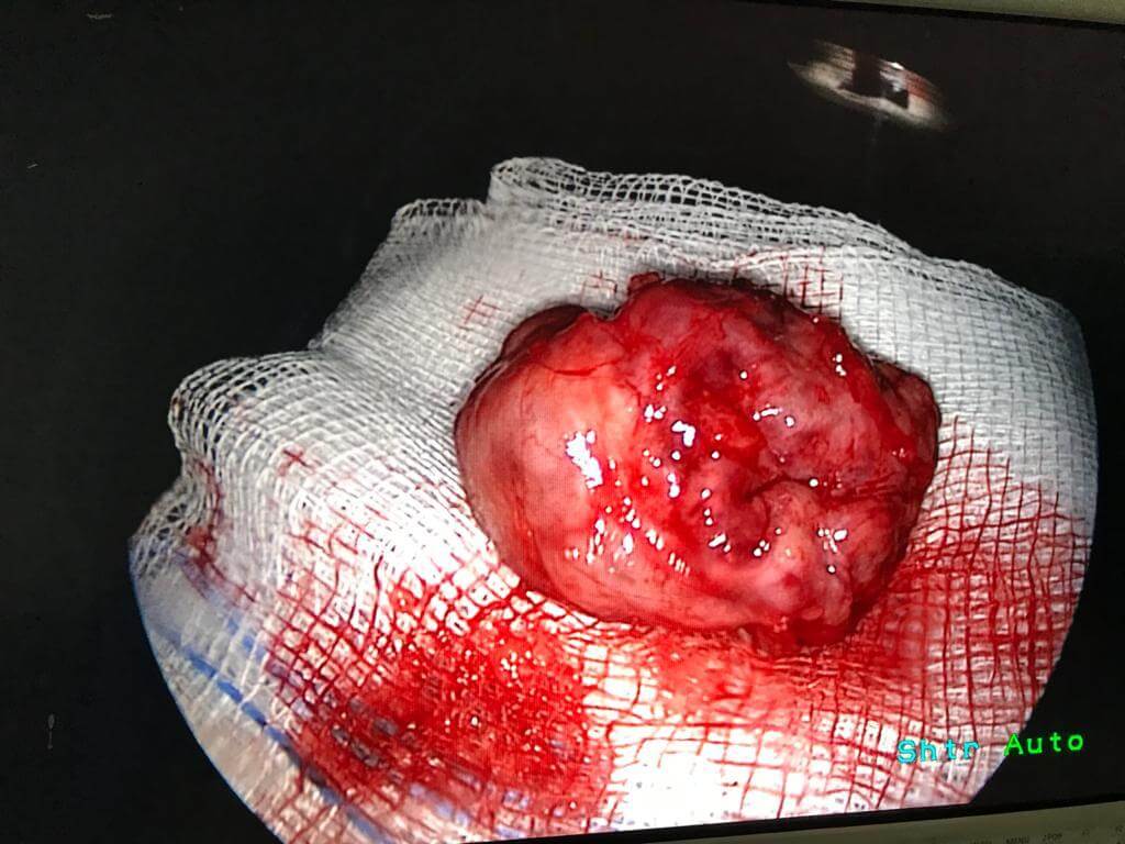 Minimal access ENT surgery